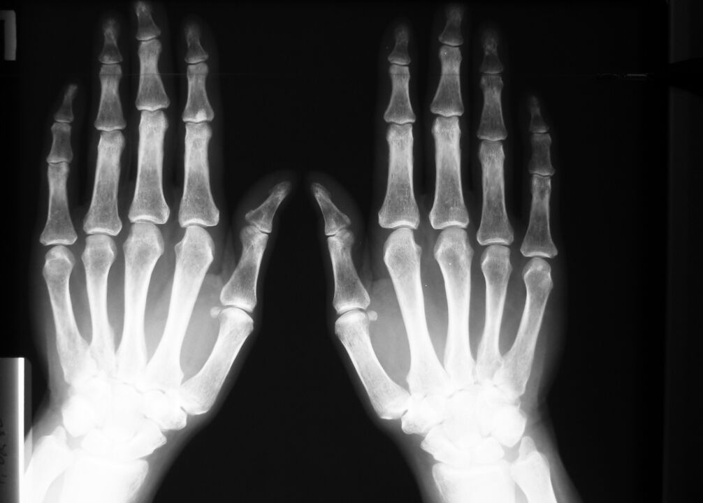 Röntgen zur Diagnose von Fingergelenkschmerzen